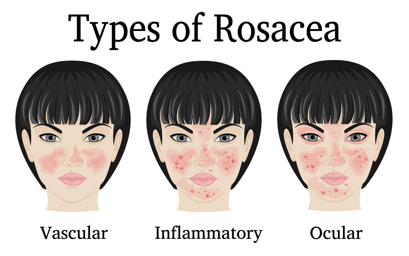 Types-of-Rosacea