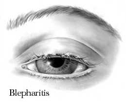 blepharitis-1