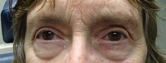 After Blepharoplasty